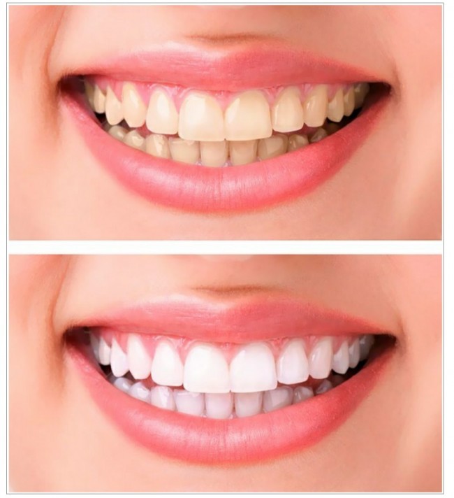 Aktivlashtirilgan ko'mir tishlar oqligi uchun