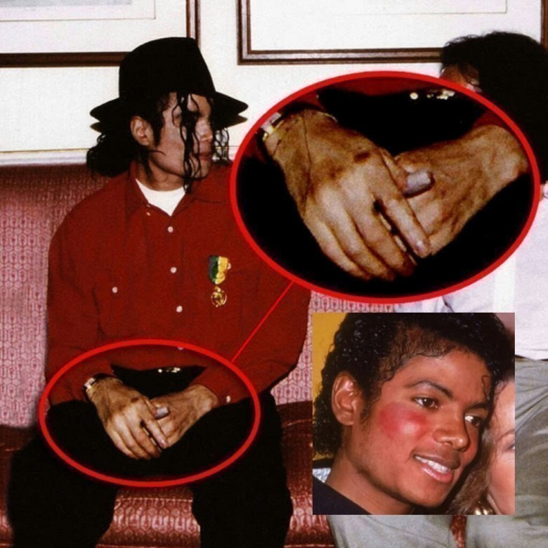 Vitiligo kasalligi